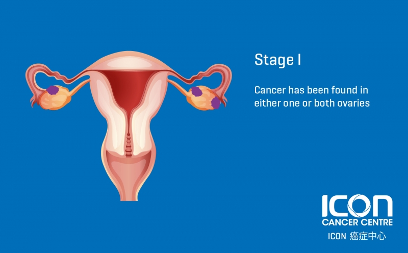 Ovarian Cancer — Icon Cancer Centre Hong Kong