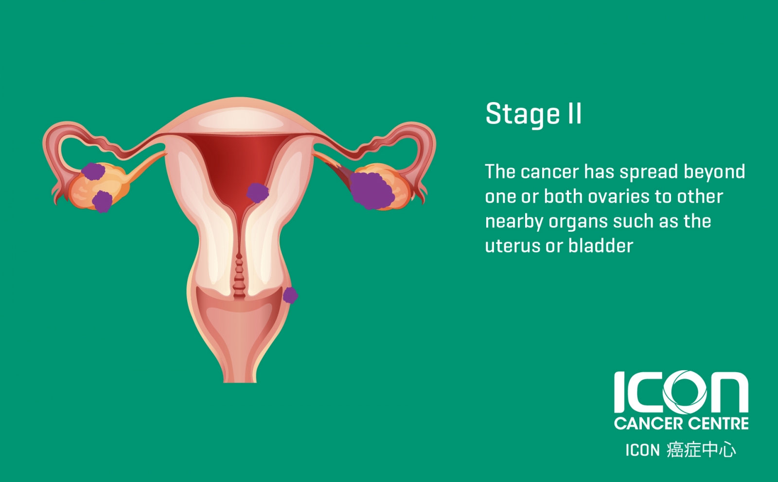 download ovarian cancer diagnosis