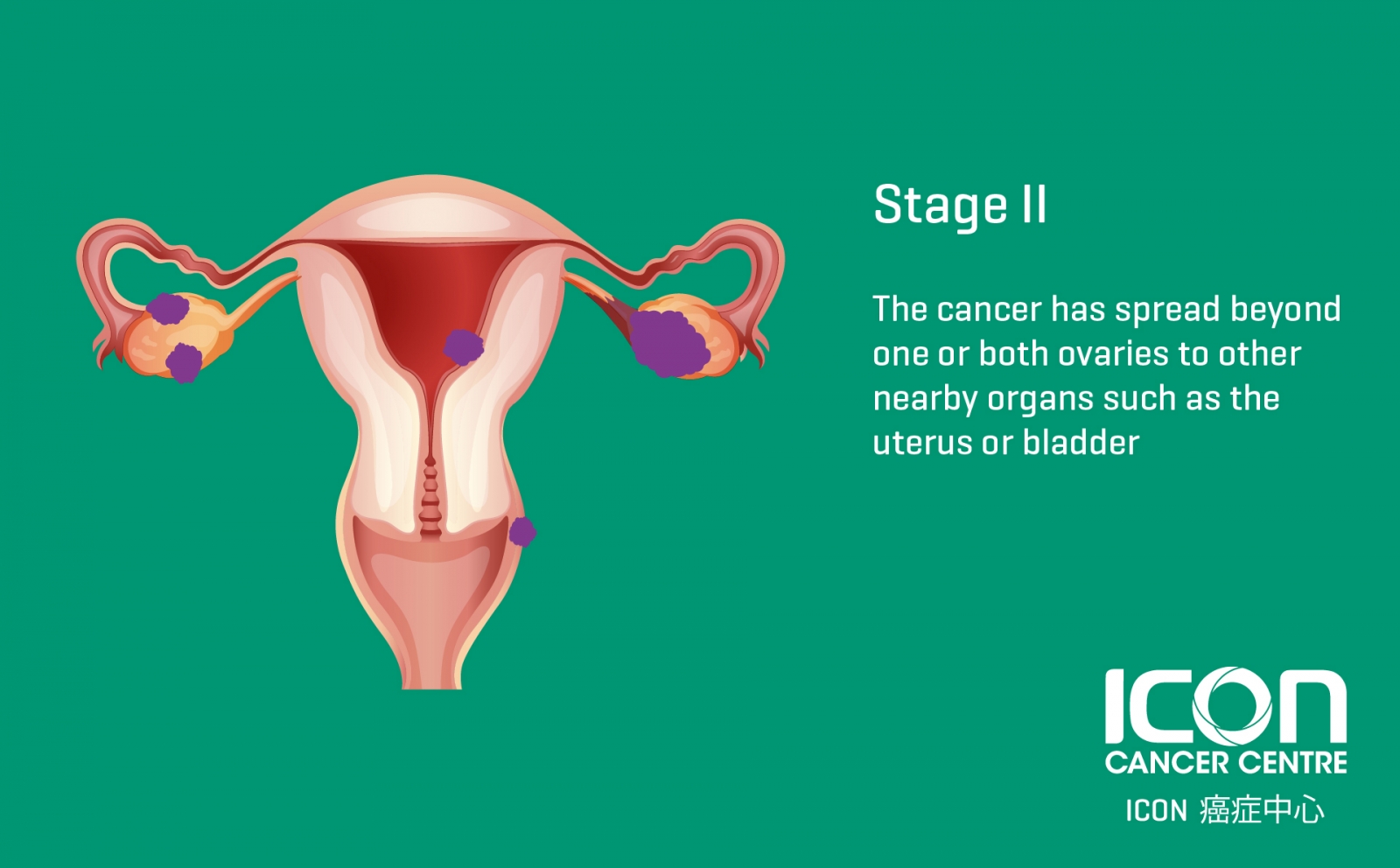 how-can-you-tell-if-you-have-ovarian-cancer-how-long-can-you-have