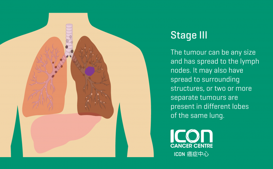 Lung Cancer — Icon Cancer Centre Hong Kong