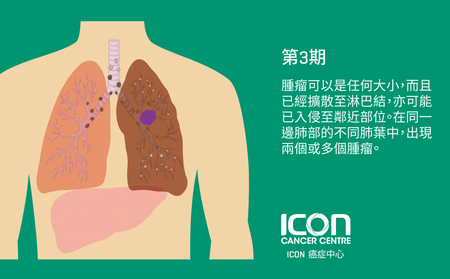 肺癌— ICON 癌症中心