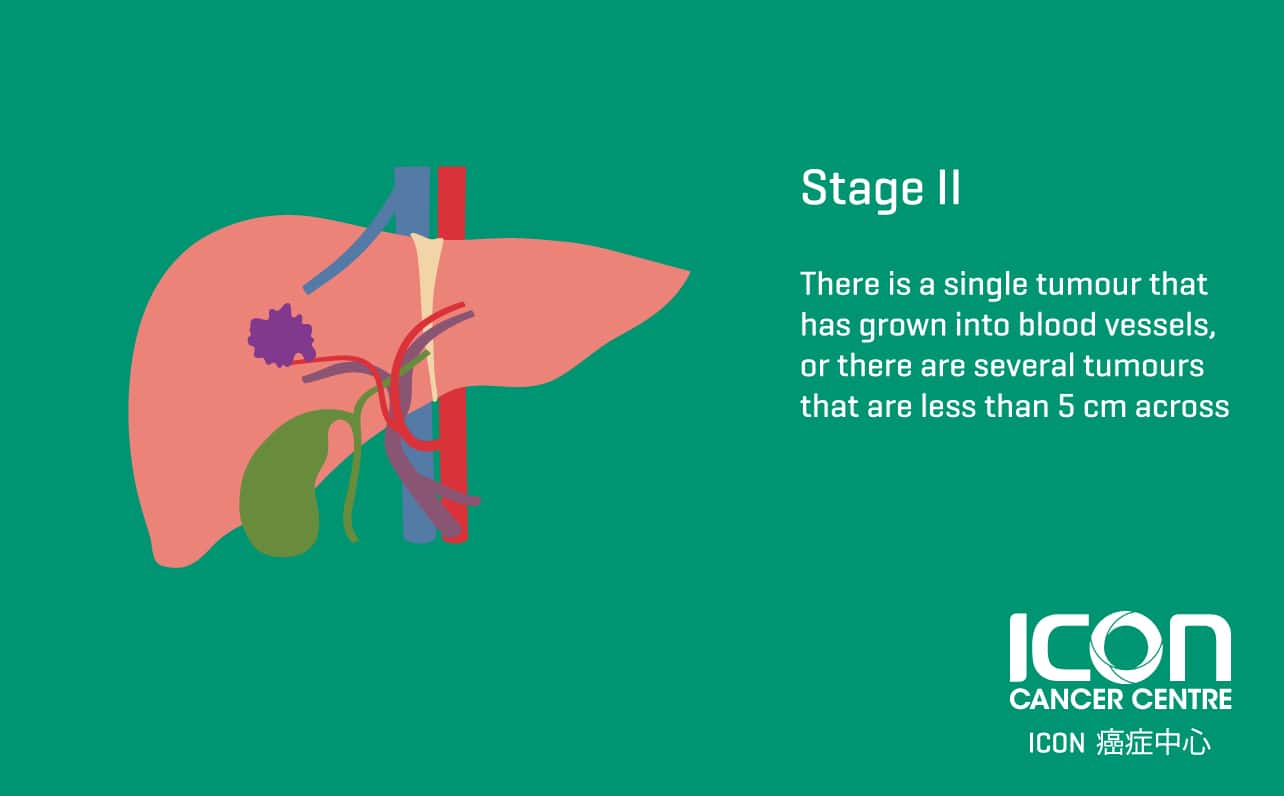 Liver Cancer — Icon Cancer Centre Hong Kong