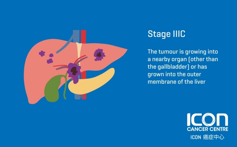 Liver Cancer — Icon Cancer Centre Hong Kong 2495