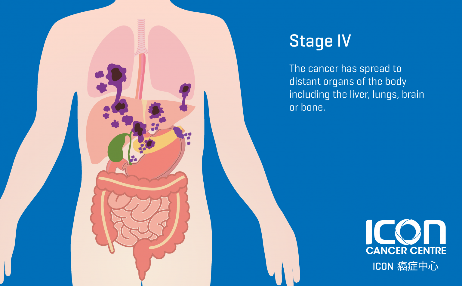 stage 4 stomach cancer symptoms